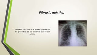 Fibrosis quística
• Las PECP son útiles en el manejo y valoración
del pronóstico de los pacientes con fibrosis
quística
 