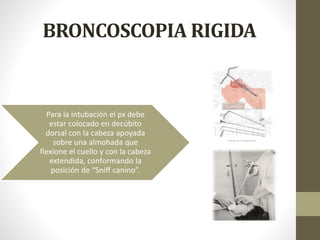 BRONCOSCOPIA RIGIDA
Para la intubación el px debe
estar colocado en decúbito
dorsal con la cabeza apoyada
sobre una almohada que
flexione el cuello y con la cabeza
extendida, conformando la
posición de “Sniff canino”.
 