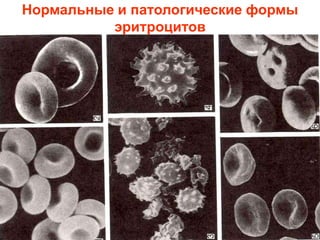 Нормальные и патологические формы
эритроцитов
 