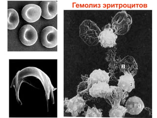 Гемолиз эритроцитов
 