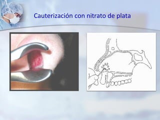 Cauterización con nitrato de plata
 