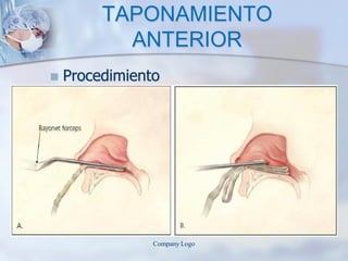 TAPONAMIENTO
ANTERIOR
 Procedimiento
Company Logo
 