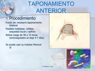 TAPONAMIENTO
ANTERIOR
 Procedimiento
Puede ser necesario taponamiento
bilateral
Posibles molestias: cefalea,
sequedad bucal y epífora
Retirar luego de 48 a 72 horas
(anticoagulados se deja 4-7 días)
Se puede usar su hubiese Merocel
®
Company Logo
 
