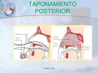 TAPONAMIENTO
POSTERIOR
Company Logo
 