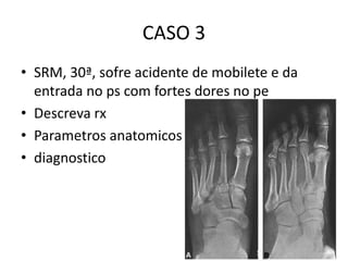 CASO 3
• SRM, 30ª, sofre acidente de mobilete e da
entrada no ps com fortes dores no pe
• Descreva rx
• Parametros anatomicos
• diagnostico
 