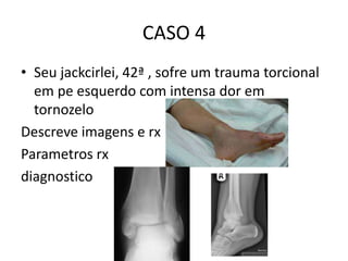 CASO 4
• Seu jackcirlei, 42ª , sofre um trauma torcional
em pe esquerdo com intensa dor em
tornozelo
Descreve imagens e rx
Parametros rx
diagnostico
 