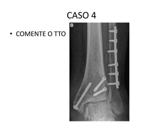 CASO 4
• COMENTE O TTO
 