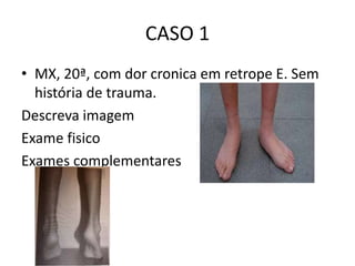 CASO 1
• MX, 20ª, com dor cronica em retrope E. Sem
história de trauma.
Descreva imagem
Exame fisico
Exames complementares
 
