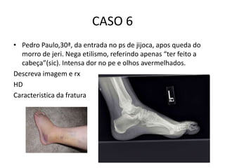 CASO 6
• Pedro Paulo,30ª, da entrada no ps de jijoca, apos queda do
morro de jeri. Nega etilismo, referindo apenas “ter feito a
cabeça”(sic). Intensa dor no pe e olhos avermelhados.
Descreva imagem e rx
HD
Caracteristica da fratura
 