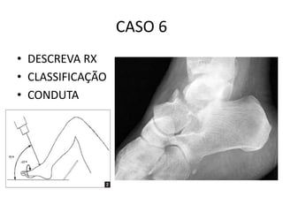 CASO 6
• DESCREVA RX
• CLASSIFICAÇÃO
• CONDUTA
 