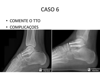 CASO 6
• COMENTE O TTO
• COMPLICAÇOES
 