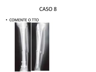CASO 8
• COMENTE O TTO
 