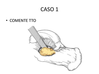 CASO 1
• COMENTE TTO
 