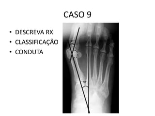 CASO 9
• DESCREVA RX
• CLASSIFICAÇÃO
• CONDUTA
 