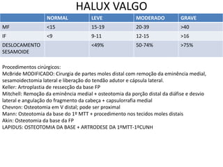 HALUX VALGO
NORMAL LEVE MODERADO GRAVE
MF <15 15-19 20-39 >40
IF <9 9-11 12-15 >16
DESLOCAMENTO
SESAMOIDE
<49% 50-74% >75%
Procedimentos cirúrgicos:
McBride MODIFICADO: Cirurgia de partes moles distal com remoção da eminência medial,
sesamoidectomia lateral e liberação do tendão adutor e cápsula lateral.
Keller: Artroplastia de ressecção da base FP
Mitchell: Remoção da eminência medial + osteotomia da porção distal da diáfise e desvio
lateral e angulação do fragmento da cabeça + capsulorrafia medial
Chevron: Osteotomia em V distal; pode ser proximal
Mann: Osteotomia da base do 1º MTT + procedimento nos tecidos moles distais
Akin: Osteotomia da base da FP
LAPIDUS: OSTEOTOMIA DA BASE + ARTRODESE DA 1ºMTT-1ºCUNH
 