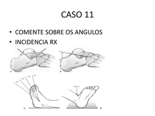 CASO 11
• COMENTE SOBRE OS ANGULOS
• INCIDENCIA RX
 
