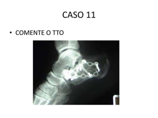 CASO 11
• COMENTE O TTO
 