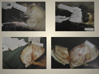Comprehensive Guide to Autopsy Procedures and Legal Protocols | PPTX