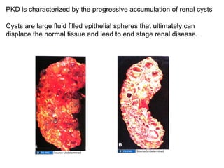 PKD is characterized by the progressive accumulation of renal cysts Cysts are large fluid filled epithelial spheres that ultimately can displace the normal tissue and lead to end stage renal disease. Source Undetermined Source Undetermined 