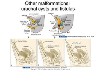 Other malformations:  urachal cysts and fistulas Langman’s Medical Embryology, 9 th  ed. 2004. 