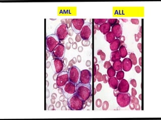 Acute Lymphoblastic Leukemia | PPT