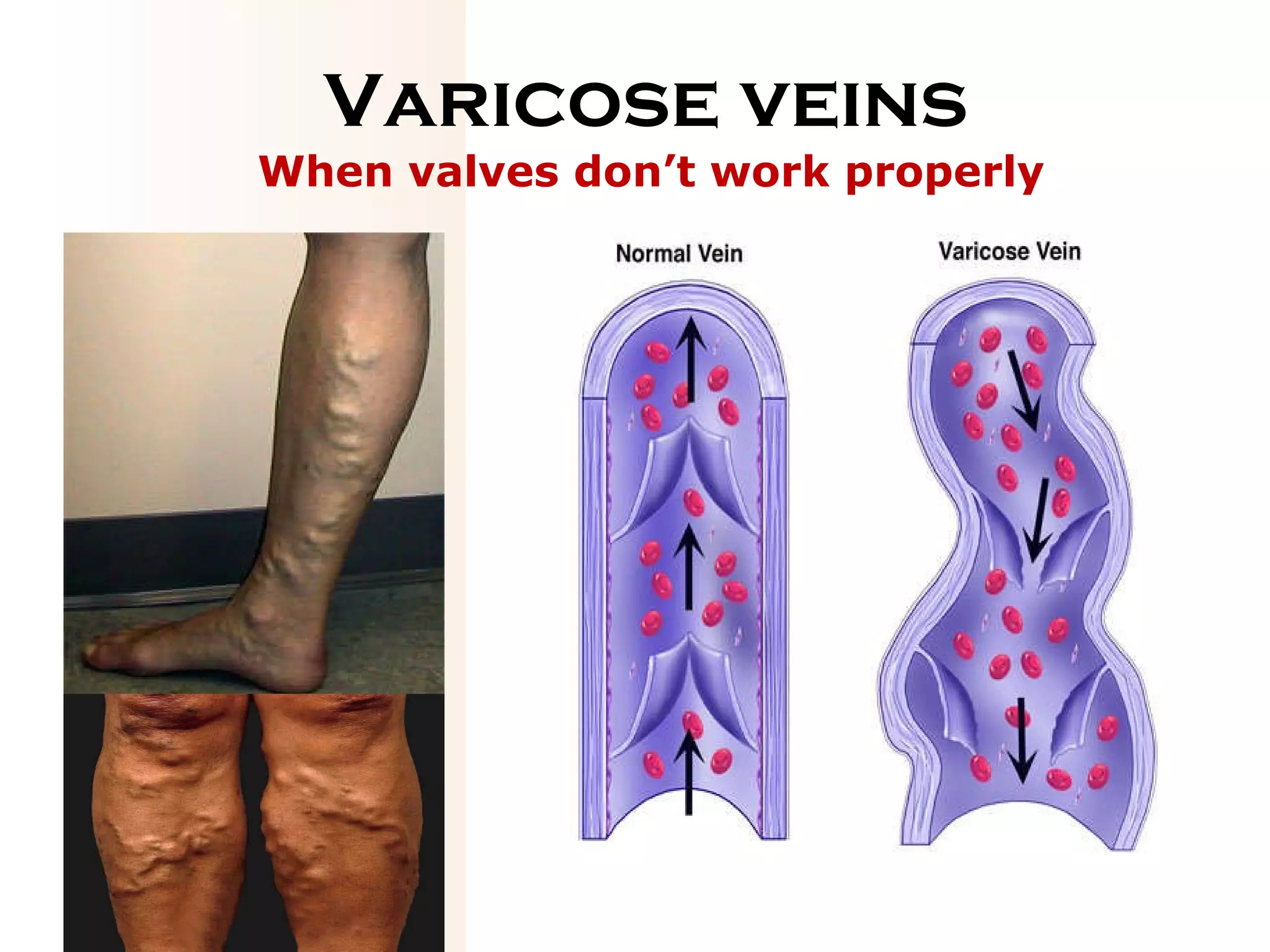 Varicose veins When valves don’t work properly 