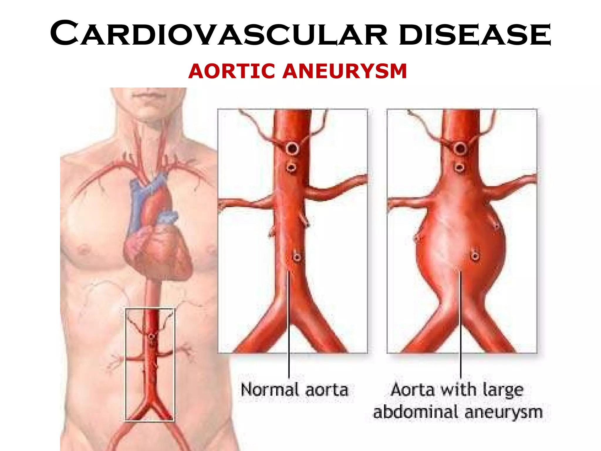 Cardiovascular disease AORTIC ANEURYSM 