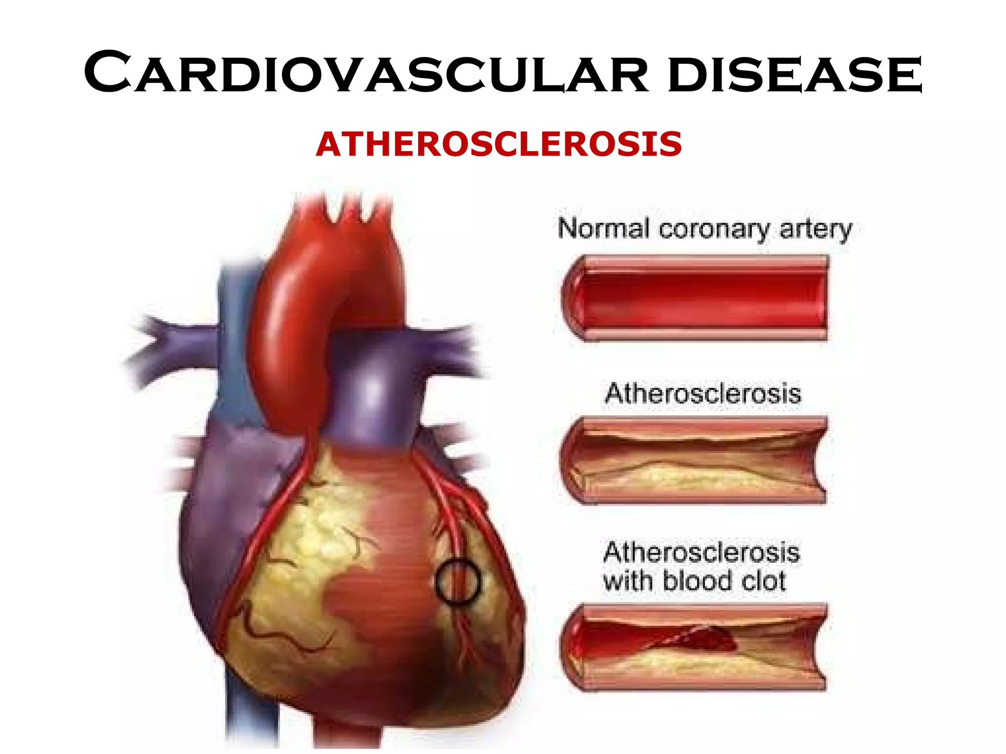 Cardiovascular disease ATHEROSCLEROSIS 