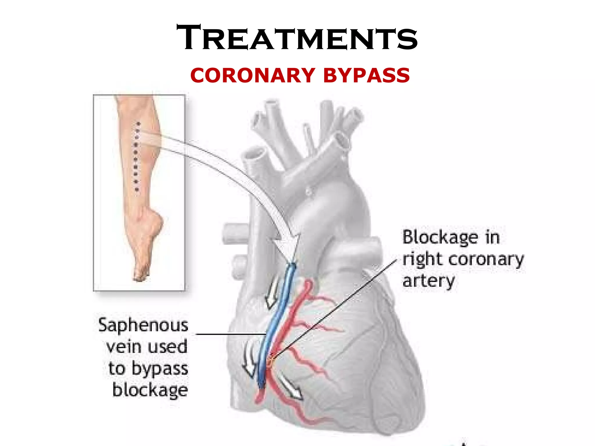 Treatments CORONARY BYPASS 
