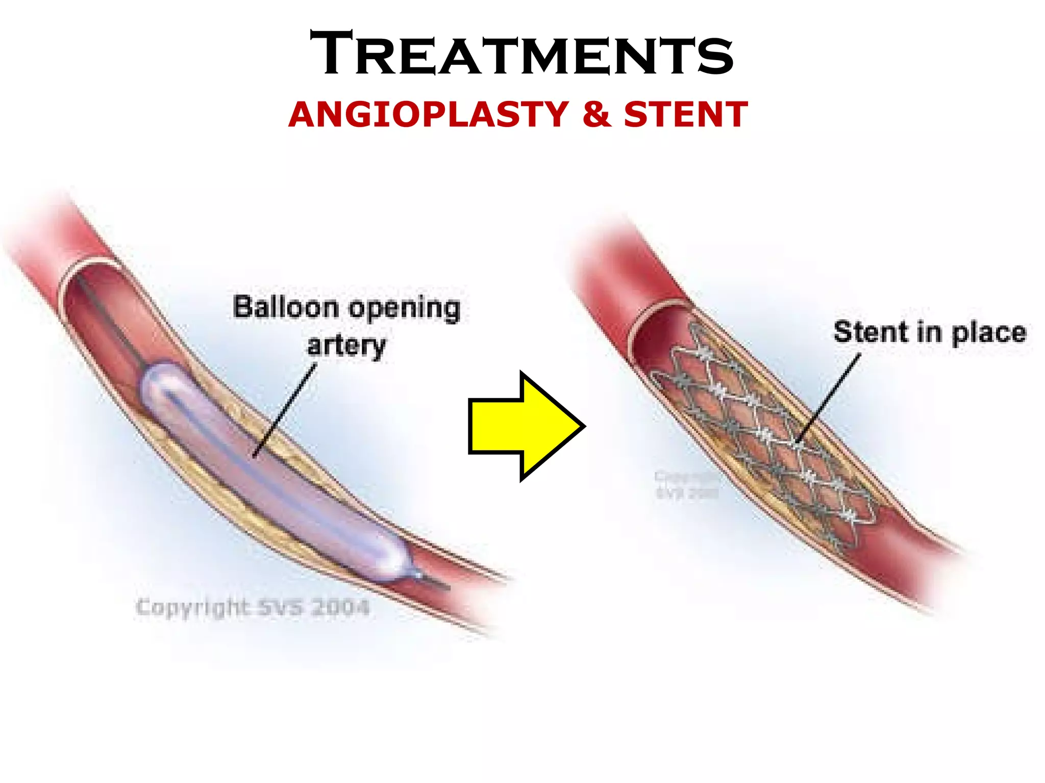Treatments ANGIOPLASTY & STENT 