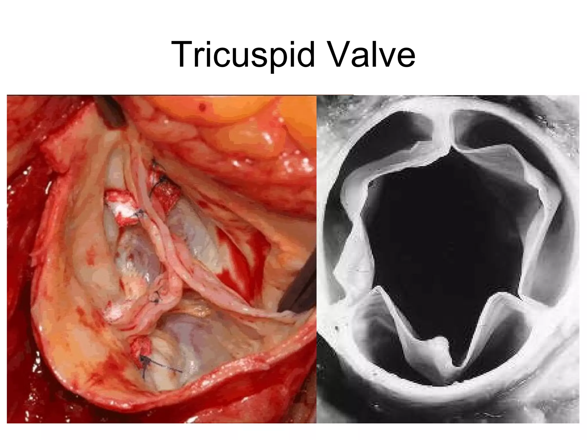 Tricuspid Valve 