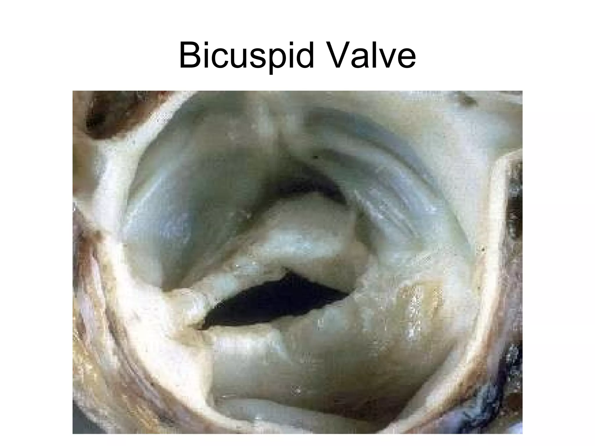 Bicuspid Valve 