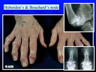 Heberden’s & Bouchard’s node 