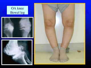 OA knee Bowel leg 