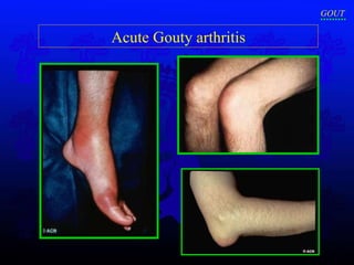 Acute Gouty arthritis GOUT 