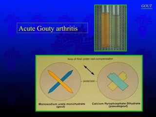 Acute Gouty arthritis GOUT 