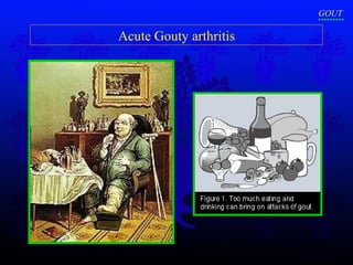 Acute Gouty arthritis GOUT 