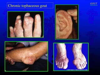 Chronic tophaceous gout GOUT 