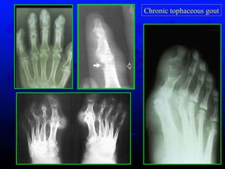 Chronic tophaceous gout 
