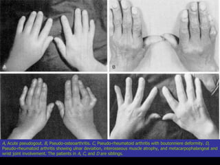 A , Acute pseudogout.  B , Pseudo-osteoarthritis.  C , Pseudo-rheumatoid arthritis with boutonniere deformity.  D , Pseudo-rheumatoid arthritis showing ulnar deviation, interosseous muscle atrophy, and metacarpophalangeal and wrist joint involvement. The patients in  A ,  C , and  D  are siblings. 