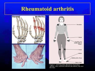 Rheumatoid arthritis 