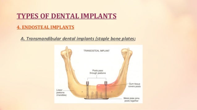 dental implant endosteal implant