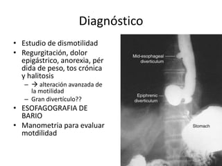 Diagnóstico
• Estudio de dismotilidad
• Regurgitación, dolor
  epigástrico, anorexia, pér
  dida de peso, tos crónica
  y halitosis
   –  alteración avanzada de
     la motilidad
   – Gran divertículo??
• ESOFAGOGRAFIA DE
  BARIO
• Manometria para evaluar
  motdilidad
 