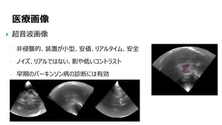 146
医療画像
超音波画像
非侵襲的、装置が小型、安価、リアルタイム、安全
ノイズ、リアルではない、影や低いコントラスト
早期のパーキンソン病の診断には有効
 