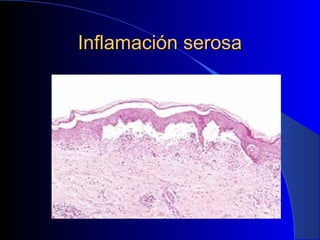 Inflamación serosa
 