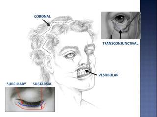 CORONAL
SUBCILIARY SUBTARSAL
TRANSCONJUNCTIVAL
VESTIBULAR
 