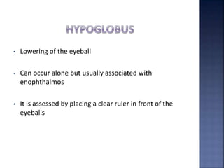 • Lowering of the eyeball
• Can occur alone but usually associated with
enophthalmos
• It is assessed by placing a clear ruler in front of the
eyeballs
 