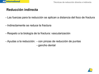 Técnicas de reducción directa e indirecta
Reducción indirecta
- Las fuerzas para la reducción se aplican a distancia del foco de fractura
- Indirectamente se reduce la fractura
- Respeto a la biología de la fractura: vascularización
- Ayudas a la reducción: - con pinzas de reducción de puntas
- gancho dental
 