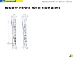 Técnicas de reducción directa e indirecta
Reducción indirecta - uso del fijador externo
 