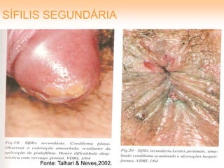 SÍFILIS SEGUNDÁRIA




     Fonte: Talhari & Neves,2002.
 